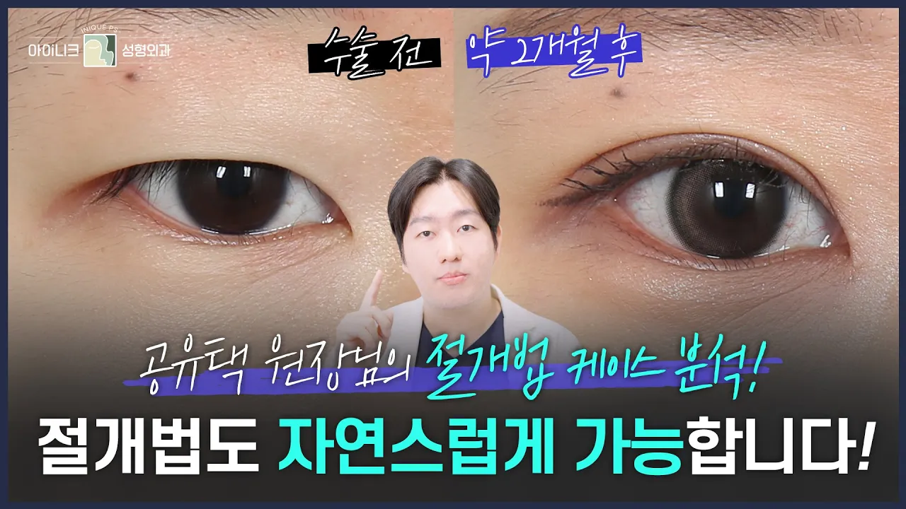 절개 쌍꺼풀+눈매교정 수술 케이스 리뷰 | 눈 수술 전문 공유택 원장님의 눈쪽상담소📝