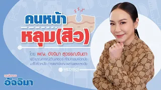 สาเหตุหลักที่ทำให้เกิดหลุมสิวคืออะไร