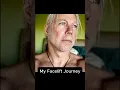 Download Lagu My Deep Facelift Journey #facelift