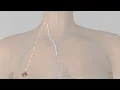 Portacatheter placement for chemo explained