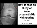How to read knee joint X-ray in knee osteoarthritis Normal Knee X ray Ortho X ray interpretation