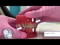 Elastics in Orthodontics - Class 2 Triangle Elastics