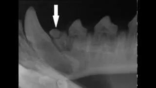 Dentigerous Cysts