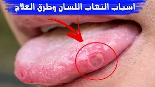 اسباب التهاب اللسان وطرق العلاج 