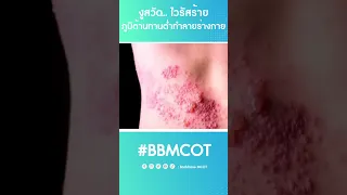  ไวรัสตัวไหนทำให้เกิดโรคสุกใสและงูสวัด และมันทำงานอย่างไรในร่างกาย 