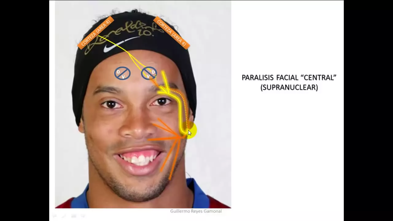 PARALISIS FACIAL CENTRAL Y PERIFERICA ANATOMIA Y SEMIOLOGIA - ACTUALIZADO