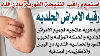 استمع وراقب النتائج رقيه الامراض الجلديه لعلاج جميع الامراض الجلديه والحكه والحبوب والحساسية 