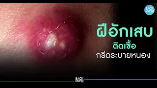 ทำไมการบีบฝีเองจึงไม่แนะนำ