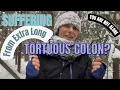Dealing With Extra Long Redundant Tortuous Colon With IBS-C