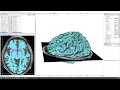 Drawing NIFTI file ROI using T1W image