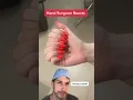 Download Lagu Too many fingers! #Polydactyly #Hand #Surgeon #Dr #Finger #Health #Medical