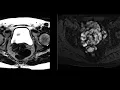 Vaginal cuff endometriosis