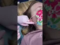 Stretching ears from 8g to 6g