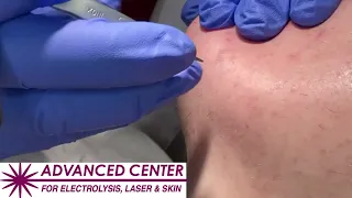Electrolysis hair removal advancedcenterforelectroly8760