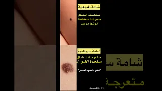 الفرق بين الشامة الطبيعية والشامة السرطانية                          طبيب مفلس   دندنها