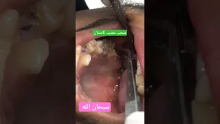 هل شاهدت عصب الاسنان من قبل سحب عصب الاسنان دكتور عبدالله سلطان الهنداوي طبيب اسنان 