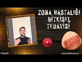 Download Lagu Zona hastalığı nedir Zona Hastalığı nasıl geçer zona rahatsızlığının bitkisel tedavisi ilmi şifa