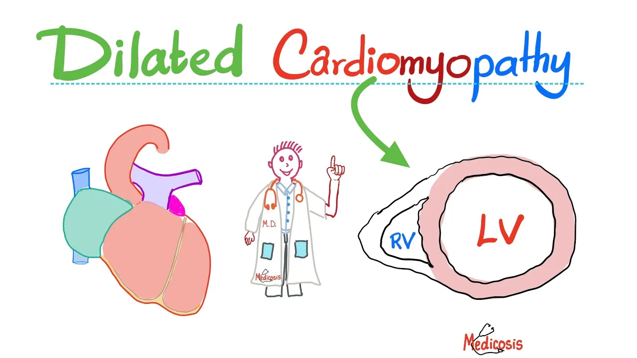 Dilated (Congestive) Cardiomyopathy (Systolic Dysfunction) - Causes, Symptoms, Diagnosis, Treatment