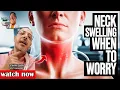 Is That Neck Lump Dangerous Swollen Lymph Nodes When to Worry