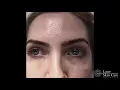 Download Lagu Tear Trough Filler Treatment - Under Eye Fillers