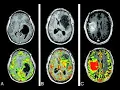 Brain Tumor Segmentation and Classification using Dense Layer Neural Network Matlab 91-8283834812