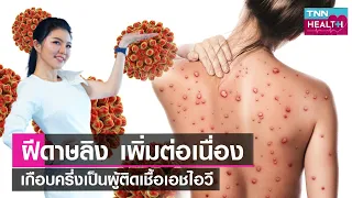 ฝีดาดลิงคือโรคอะไร และมีอาการอย่างไรบ้าง