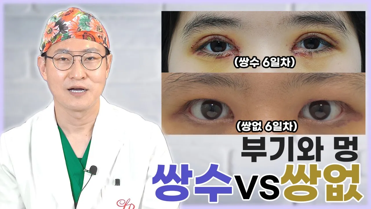 쌍수 후에 생기는 부기와 멍! 과연 쌍없수술을 해도 생길까요? | 라리성형외과