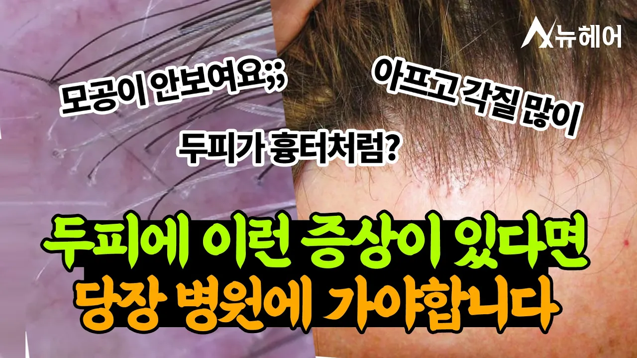 두피가 흉터처럼..? 당장 치료해야 합니다!ㅣ전두섬유성탈모ㅣ뉴헤어