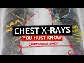 Download Lagu 10 MUST KNOW Chest X-Rays For Medical/PA Finals | CXRs Made Easy