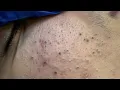 ASMR Deep Pore Cleansing and Blackheads Removal Techniques