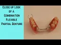 Flexible Partial Denture a close look at a combination flexible partial denture
