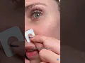 How An Esthetician Gets Rid Of A Pimple In 1 Day Zitsticka Killa Patch