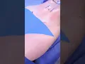 Next-Level Contour Lipo 360 Vaser at Vive Plastic Surgery