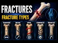 Understanding fractures When bones break