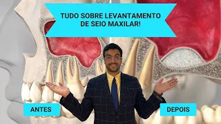 LEVANTAMENTO DE SEIO MAXILAR! Tudo que você precisa saber!