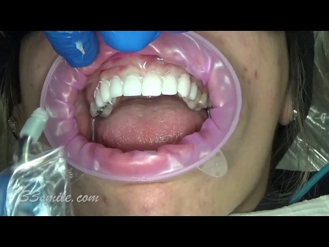 Download MP3 porcelain dental veneers before and after cosmetic dentistry