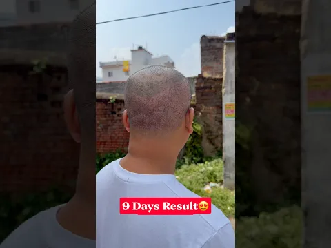 9 Days After Hair Transplant 😱 Scab Hatne Ke Baad Kaisa Laga? #shorts #9daysresult #beforeafter