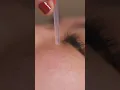 Can acupuncture make you look younger