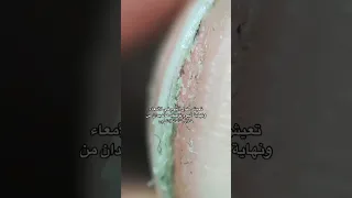 ديدان البطن 