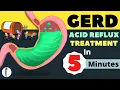 Download Lagu GERD Treatment | Acid Reflux Treatment | Heartburn Treatment - All You Need to Know