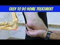 Elbow Bursitis Treatment at Home - How to Treat Olecranon Bursitis