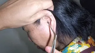 Cotton STUCK DEEP Inside Woman's Ear Removed