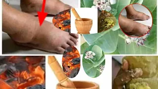 maganin kumburin qafa mujarabun kokuma kumburinjiki da yardan allah