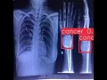 Bone Tumor Cancer Detection Yolov8 Computer Vision Healthcare Yolo Project