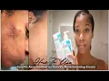 How to use CeraVe Acne Control Cleanser vs CeraVe Acne Foaming Cream Cleanser 30 Day Review