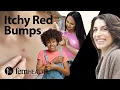 Dermatologist breaks down 7 causes of red itchy bumps What your rash might be