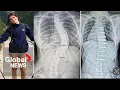 Alberta teen s family sues government after 200K US scoliosis surgery bill