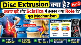 Disc Extrusion क्या है? | कमर दर्द और Sciatica में इसका क्या Role है? | पूरा Mechanism | Part 3