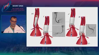 Results Of The TAMBE Phase One Trial For The Treatment Of Juxtrarenal Aneurysms