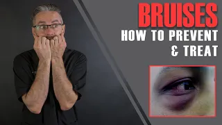 Download FILLER BRUISES: Dr Tim's 16 Essential Tips To Prevent \u0026 Minimise Bruises [Aesthetics Mastery Show] MP3